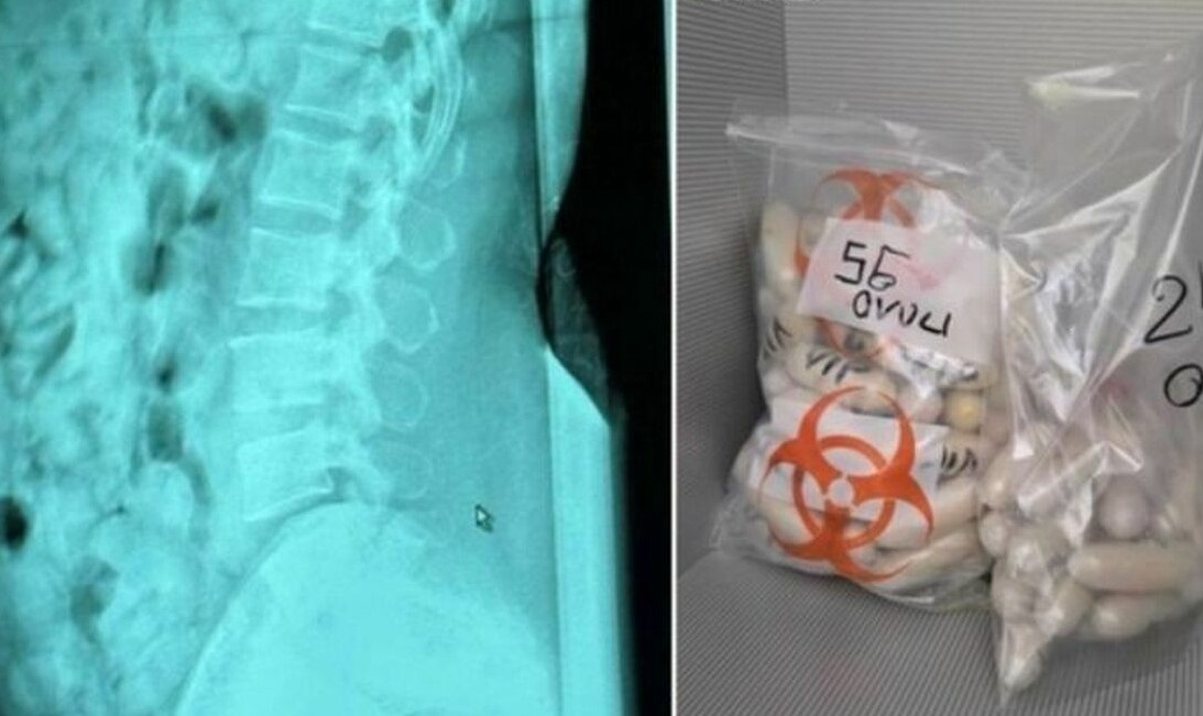 В Італії затримано жінку з 1,4 кг героїну в шлунку